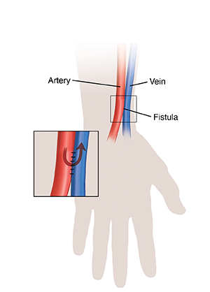 Creating a Hemodialysis Access